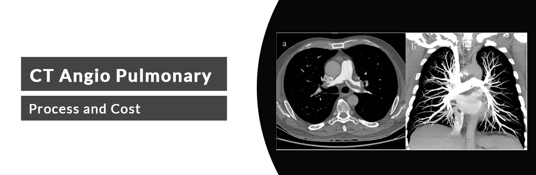 CT Angio Pulmonary: Process and Cost